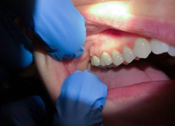 Best Dental Abscess Treatment in Lititz, PA